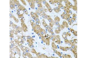 Immunohistochemistry of paraffin-embedded Human liver damage using TOB2 Polyclonal Antibody at dilution of 1:100 (40x lens). (TOB2 anticorps)