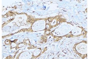 ABIN6275279 at 1/100 staining Human lung cancer tissue by IHC-P.