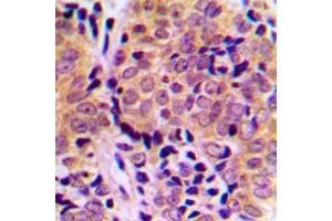 Immunohistochemical analysis of 4EBP1 (pT46) staining in human breast cancer formalin fixed paraffin embedded tissue section.