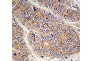 IHC analysis of FFPE human hepatocarcinoma tissue stained with Apolipoprotein A-II antibody (APOA2 anticorps  (AA 28-56))