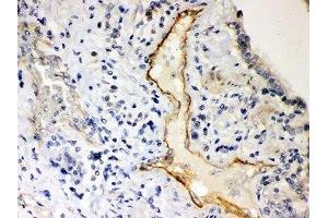 IHC-P: P2X2 antibody testing of human lung cancer tissue (P2RX2 anticorps  (AA 139-471))