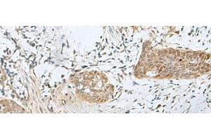 Immunohistochemistry of paraffin-embedded Human esophagus cancer tissue using SNRPD1 Polyclonal Antibody at dilution of 1:70(x200) (SNRPD1 anticorps)