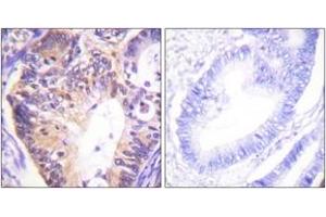Immunohistochemistry analysis of paraffin-embedded human colon carcinoma tissue, using PAK1 (Ab-212) Antibody. (PAK1 anticorps  (AA 178-227))