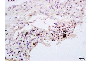 Formalin-fixed and paraffin embedded human lung carcinoma labeled with Rabbit Anti TNFAIP3/A20 Polyclonal Antibody, Unconjugated  at 1:200 followed by conjugation to the secondary antibody and DAB staining (TNFAIP3 anticorps  (AA 51-150))