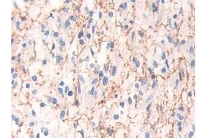 Detection of MAP2K1 in Human Glioma Tissue using Polyclonal Antibody to Mitogen Activated Protein Kinase Kinase 1 (MAP2K1)