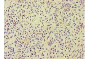 Immunohistochemistry of paraffin-embedded human breast cancer using ABIN7155980 at dilution of 1:100 (ALOXE3 anticorps  (AA 1-280))