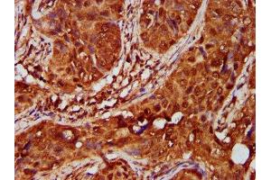 IHC image of ABIN7151572 diluted at 1:600 and staining in paraffin-embedded human cervical cancer performed on a Leica BondTM system.