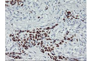 Immunohistochemical staining of paraffin-embedded Carcinoma of Human lung tissue using anti-TP53 mouse monoclonal antibody. (p53 anticorps)