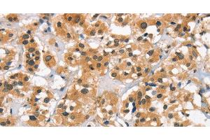 Immunohistochemistry of paraffin-embedded Human thyroid cancer tissue using Cav1.