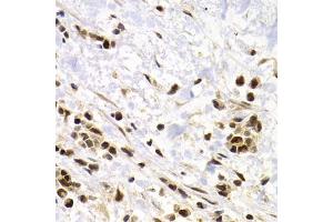 Immunohistochemistry of paraffin-embedded human kidney cancer using SUMO4 Antibody (ABIN5971586) at dilution of 1/200 (40x lens). (SUMO4 anticorps)
