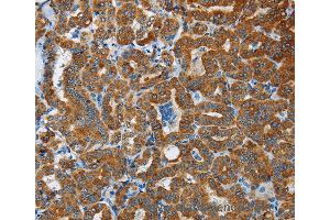 Immunohistochemistry of Human liver cancer using FLCN Polyclonal Antibody at dilution of 1:40 (FLCN anticorps)
