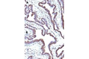 Immunohistochemical staining (Formalin-fixed paraffin-embedded sections) of human ovarian cancer (A, B) with FBXO5 monoclonal antibody, clone EMI1/1176 . (FBXO5 anticorps  (AA 1-250))