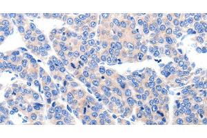 Immunohistochemistry of paraffin-embedded Human ovarian cancer tissue using KCNH8 Polyclonal Antibody at dilution 1:50 (KCNH8 anticorps)