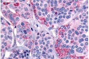 Human Thyroid, Medullary Carcinoma (formalin-fixed, paraffin-embedded) stained with CALCR antibody ABIN213557 at 20 ug/ml followed by biotinylated goat anti-rabbit IgG secondary antibody ABIN481713, alkaline phosphatase-streptavidin and chromogen. (Calcitonin Receptor anticorps  (C-Term))