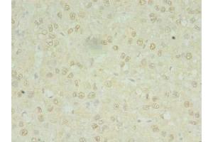 Immunohistochemistry of paraffin-embedded human liver cancer using ABIN7142391 at dilution of 1:100 (MRPL3 anticorps  (AA 201-348))