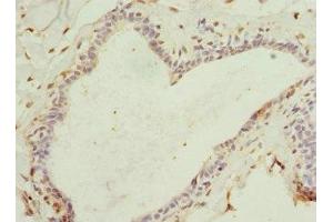 Immunohistochemistry of paraffin-embedded human breast cancer using ABIN7167073 at dilution of 1:100 (HBXIP anticorps  (AA 1-91))