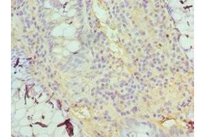 Immunohistochemistry of paraffin-embedded human colon cancer using ABIN7153379 at dilution of 1:100 (TDG anticorps  (AA 141-410))