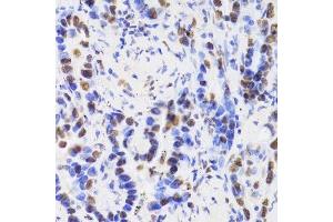 Immunohistochemistry of paraffin-embedded human lung cancer using HDGF Antibody. (HDGF anticorps  (AA 1-240))
