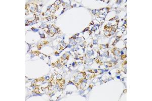 Immunohistochemistry of paraffin-embedded human breast cancer using USP33 antibody (ABIN7271157) at dilution of 1:100 (40x lens).