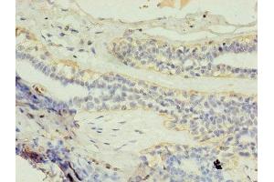 Immunohistochemistry of paraffin-embedded human breast cancer using ABIN7154147 at dilution of 1:100