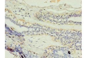 Immunohistochemistry of paraffin-embedded human breast cancer using ABIN7154147 at dilution of 1:100 (GK2 anticorps  (AA 2-553))