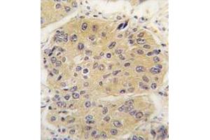 Formalin-Fixed, Paraffin-Eembedded Human lung carcinoma tissue stained with EIF4A1 Antibody (N-term),which was peroxidase-conjugated to the secondary antibody, followed by DAB staining. (EIF4A1 anticorps  (N-Term))
