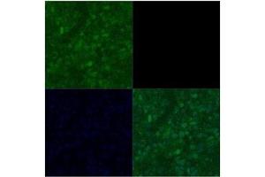 Primary Metastatic Melenoma Speciman Primary antibody dilution: 1:1000