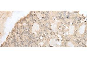 Immunohistochemistry of paraffin-embedded Human colorectal cancer tissue using ZZZ3 Polyclonal Antibody at dilution of 1:50(x200) (ZZZ3 anticorps)