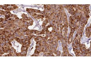 ABIN6267142 at 1/100 staining Human thyroid cancer tissue by IHC-P.