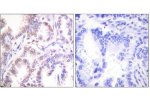 Immunohistochemistry analysis of paraffin-embedded human lung carcinoma tissue using CDK7 antibody.