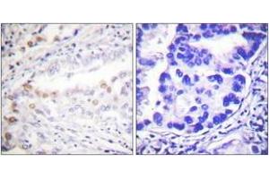 Immunohistochemistry analysis of paraffin-embedded human lung carcinoma tissue, using Uba2 Antibody. (UBA2 anticorps  (AA 591-640))