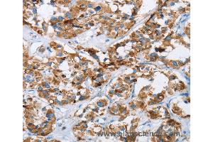 Immunohistochemistry of Human cervical cancer using HINT2 Polyclonal Antibody at dilution of 1:40 (HINT2 anticorps)