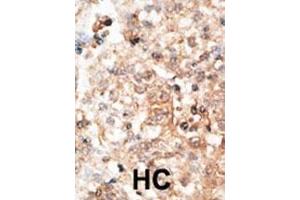 Formalin-fixed and paraffin-embedded human cancer tissue reacted with the primary antibody, which was peroxidase-conjugated to the secondary antibody, followed by DAB staining.