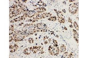 IHC-P: MCM2 antibody testing of human lung cancer tissue (MCM2 anticorps  (C-Term))