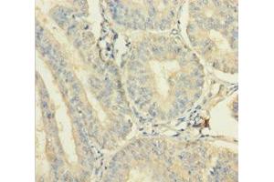 Immunohistochemistry of paraffin-embedded human endometrial cancer using ABIN7175017 at dilution of 1:100 (C12orf49 anticorps  (AA 34-205))