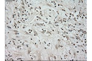 Immunohistochemical staining of paraffin-embedded Carcinoma of kidney tissue using anti-BUB1Bmouse monoclonal antibody. (BUB1B anticorps)