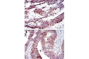 Immunohistochemical analysis of paraffin-embedded human ovarian cancer (A) and human rectum cancer (B) tissues using CYP1A1 monoclonal antibody, clone 6G5  with DAB staining.