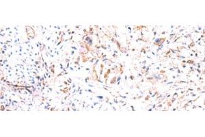 Immunohistochemistry of paraffin-embedded Human cervical cancer tissue using PHKG2 Polyclonal Antibody at dilution of 1:60(x200) (PHKG2 anticorps)
