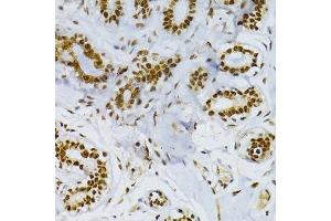 Immunohistochemistry of paraffin-embedded human breast cancer using SNRNP70 antibody.