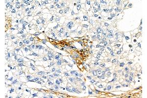 ABIN6261386 and ABIN6277474 at 1/100 staining Human pancreatic cancer by IHC-P.