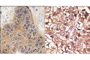 (LEFT)Formalin-fixed and paraffin-embedded human hepatocarcinoma tissue reacted with CHIP (STUB1) antibody (C-term), which was peroxidase-conjugated to the secondary antibody, followed by DAB staining. (STUB1 anticorps  (C-Term))