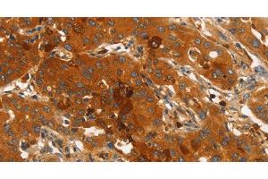 Immunohistochemistry of paraffin-embedded Human lung cancer using ORM2 Polyclonal Antibody at dilution of 1:40 (Orosomucoid 2 anticorps)