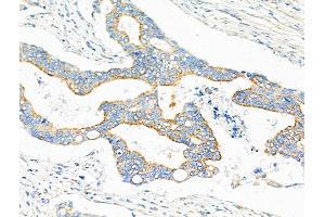 ABIN6259122 and ABIN6275275 at 1/100 staining Human colorectal cancer by IHC-P. (NDUFV2 anticorps  (N-Term))