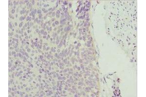 Immunohistochemistry of paraffin-embedded human cervical cancer using ABIN7176006 at dilution of 1:100 (ZNF187 anticorps  (AA 239-478))