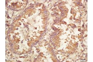 Formalin-fixed and paraffin embedded human lung carcinoma labeled with Rabbit Anti-Caspase-9 (Ser196) Polyclonal Antibody, Unconjugated (ABIN756922) at 1:200 followed by conjugation to the secondary antibody and DAB staining (Caspase 9 anticorps  (pSer196))