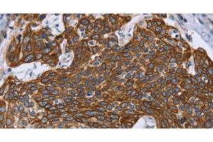 Immunohistochemistry of paraffin-embedded Human cervical cancer using GRPR Polyclonal Antibody at dilution of 1:40