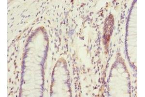 Immunohistochemistry of paraffin-embedded human colon cancer using ABIN7172903 at dilution of 1:100