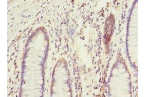 Immunohistochemistry of paraffin-embedded human colon cancer using ABIN7172903 at dilution of 1:100 (EIF2B2 anticorps  (AA 1-351))