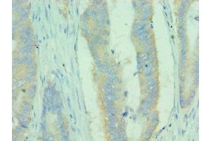 Immunohistochemistry of paraffin-embedded human colon cancer using ABIN7159681 at dilution of 1:100 (MICA anticorps  (AA 24-307))
