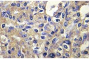 Immunohistochemistry (IHC) analyzes of MELK antibody in paraffin-embedded human liver carcinoma tissue. (MELK anticorps)